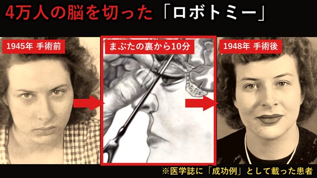 4万人の脳を切ったロボトミー